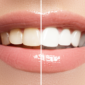 Dunkle und helle Zähne nach Behandlung im Vergleich